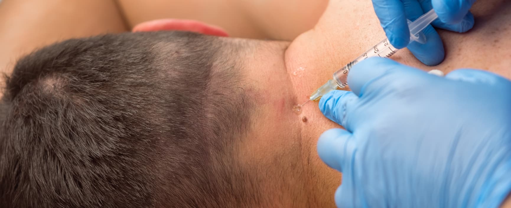 Patient receiving cervical facet injection in neck