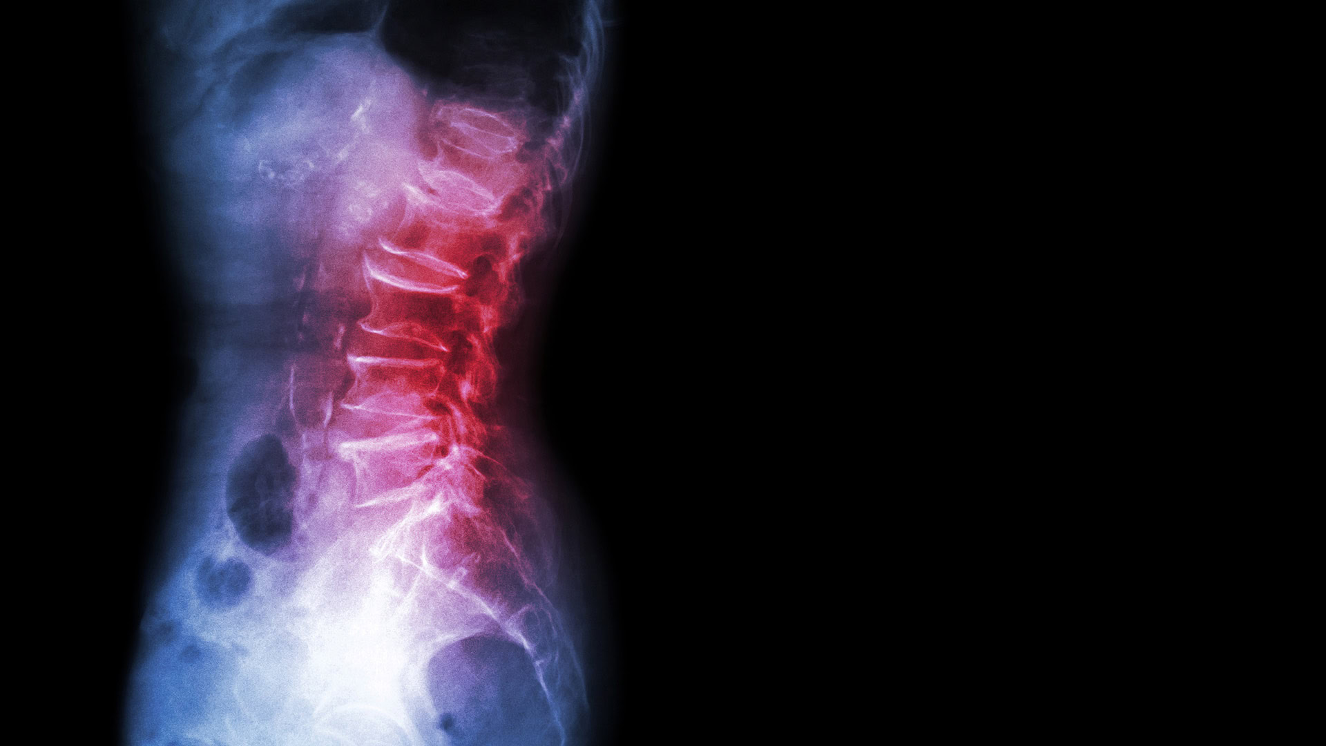X-ray showing spondylolisthesis in lumbar spine