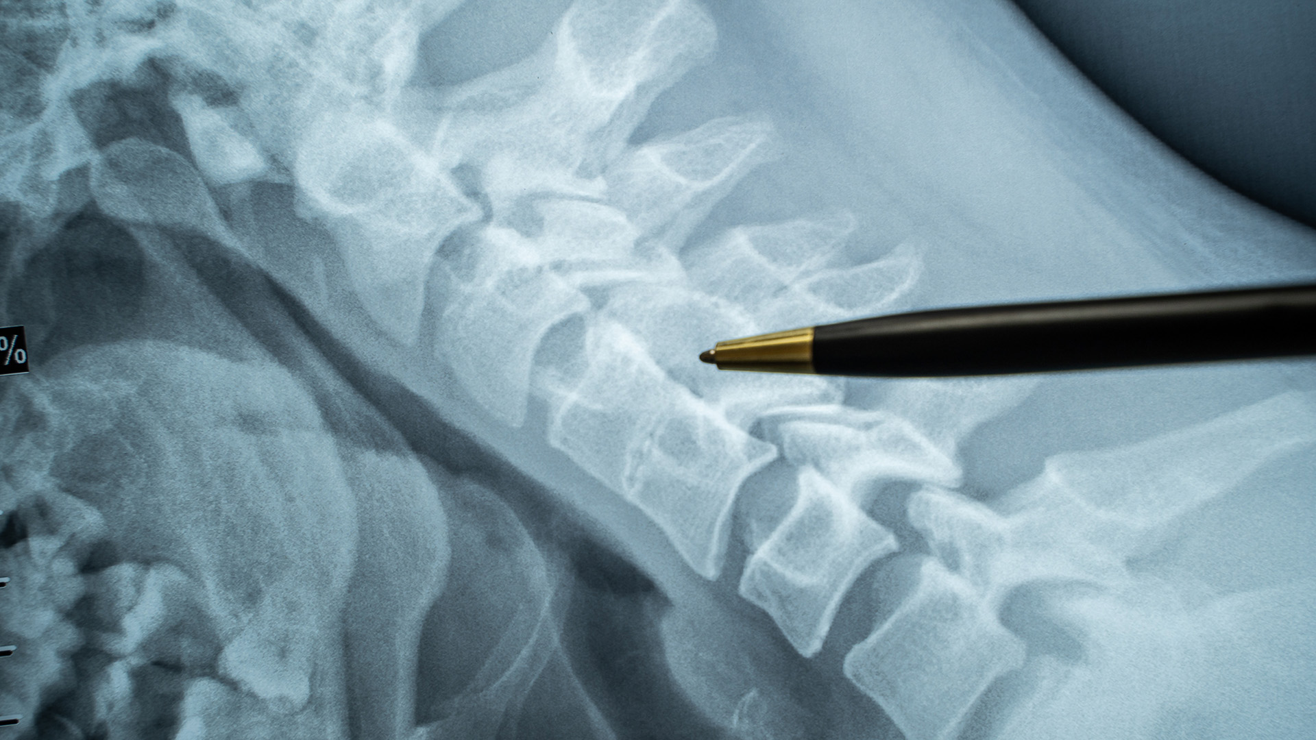 Doctor reviewing spine CT scan for epidural procedure