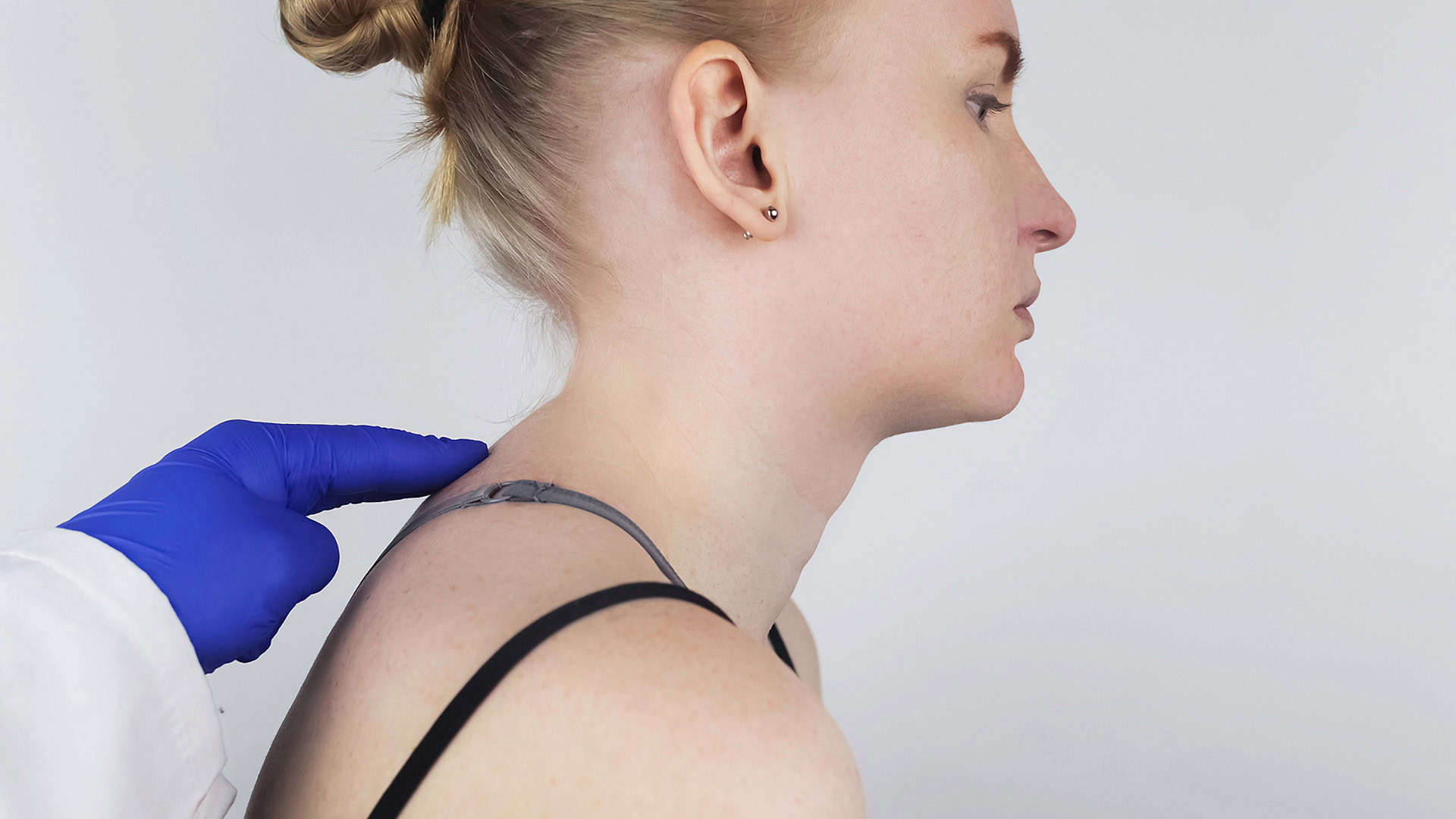 Woman with kyphosis spinal curvature