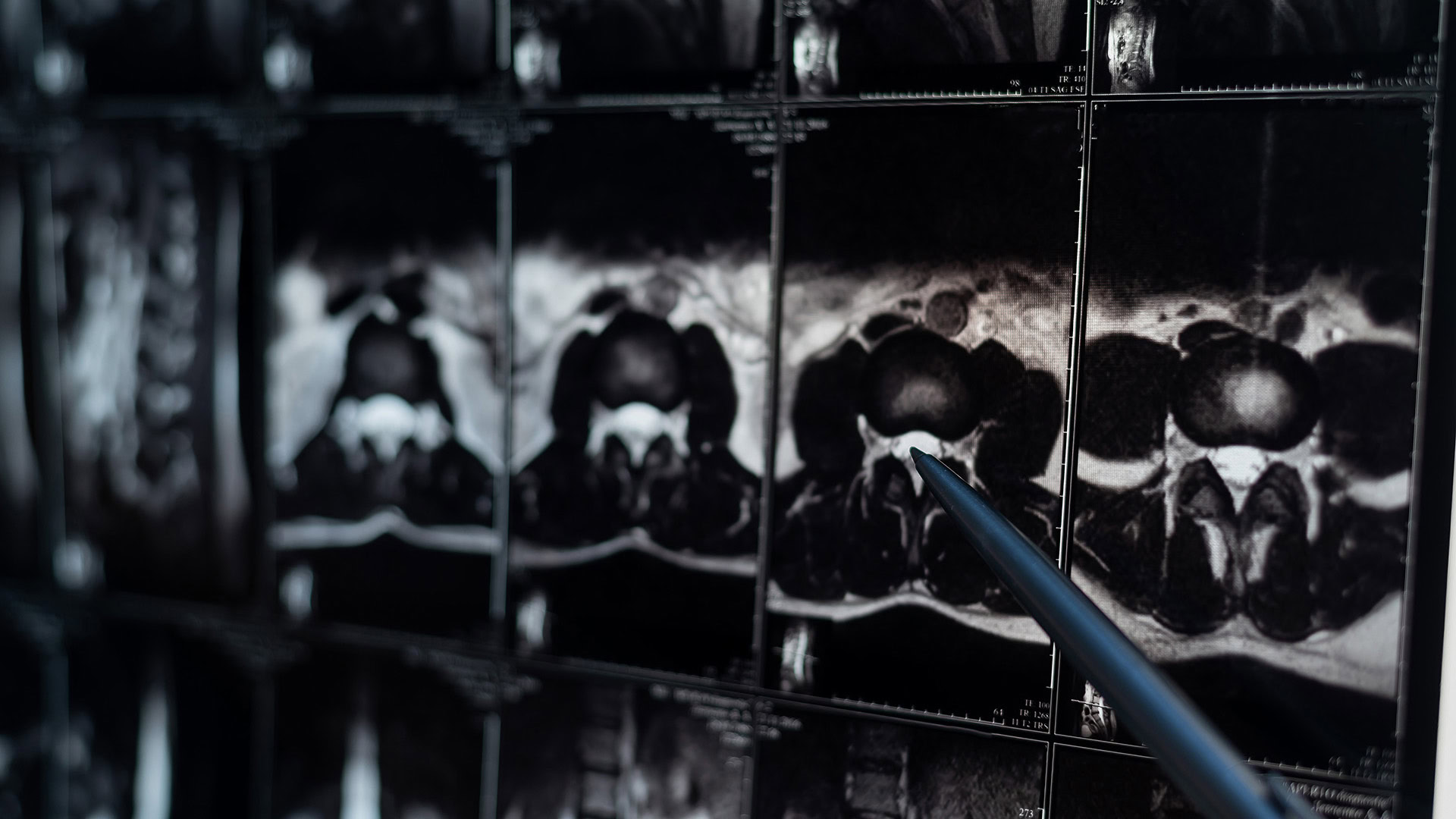 Doctor pointing at lumbar spine MRI scan