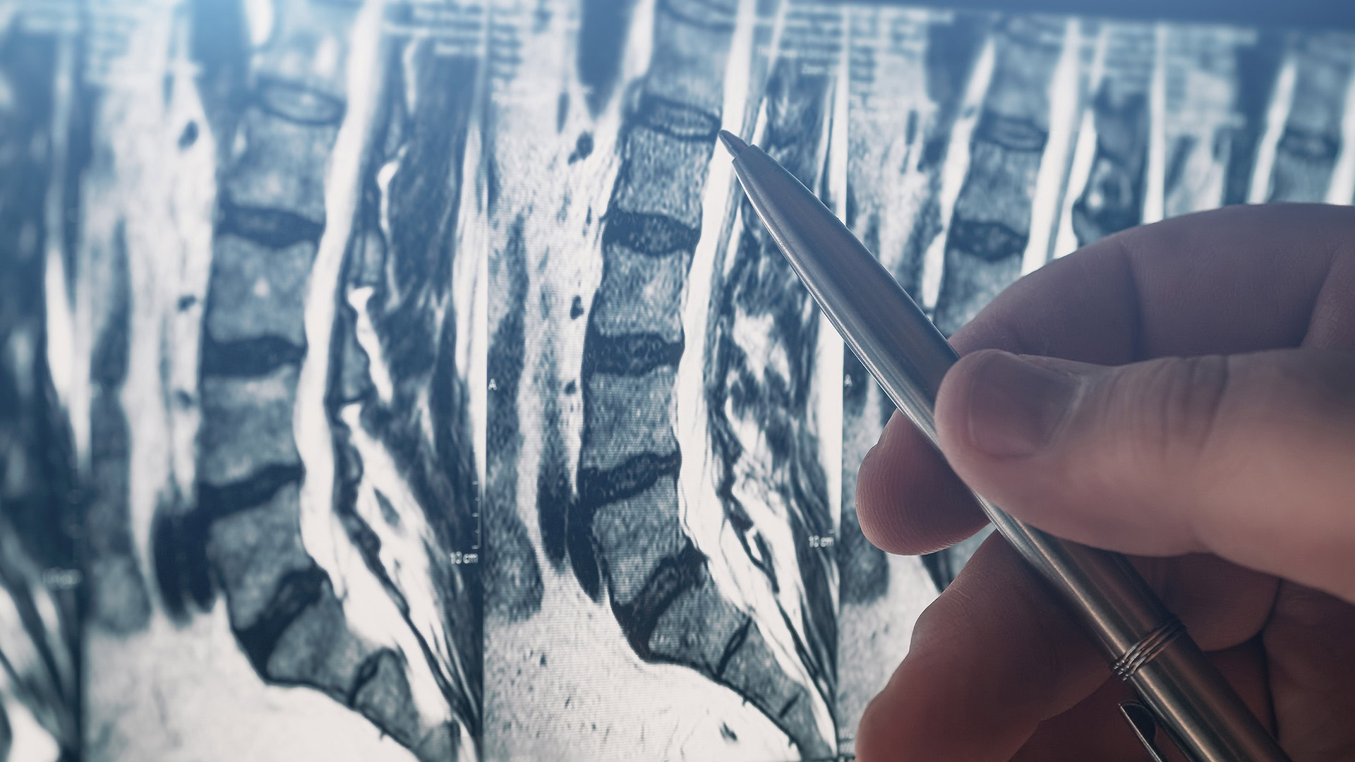 Doctor examining lumbar spine MRI scan